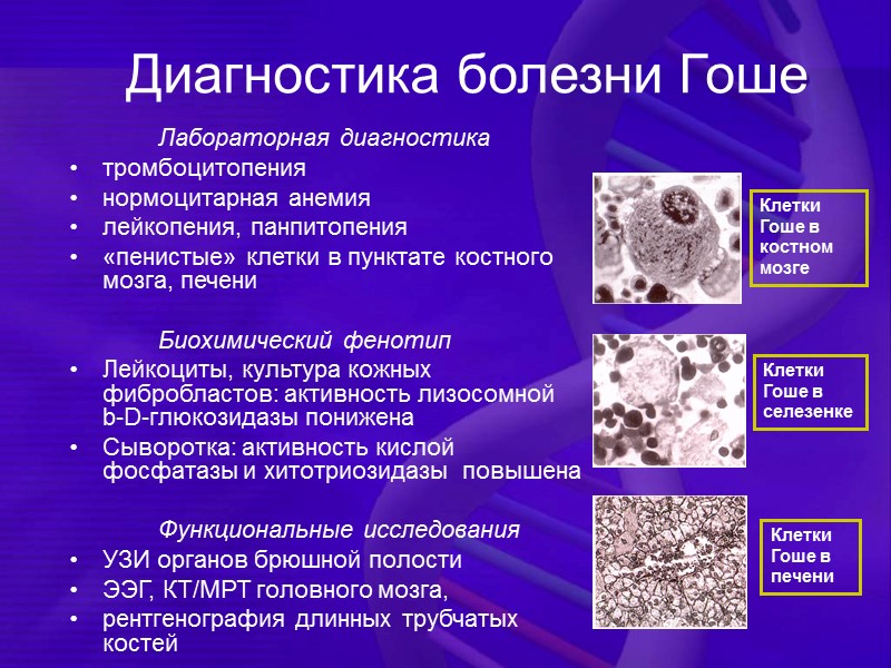 Диагностика болезни Гоше   Лабораторная диагностика тромбоцитопения  нормоцитарная анемия лейкопения, панпитопения 